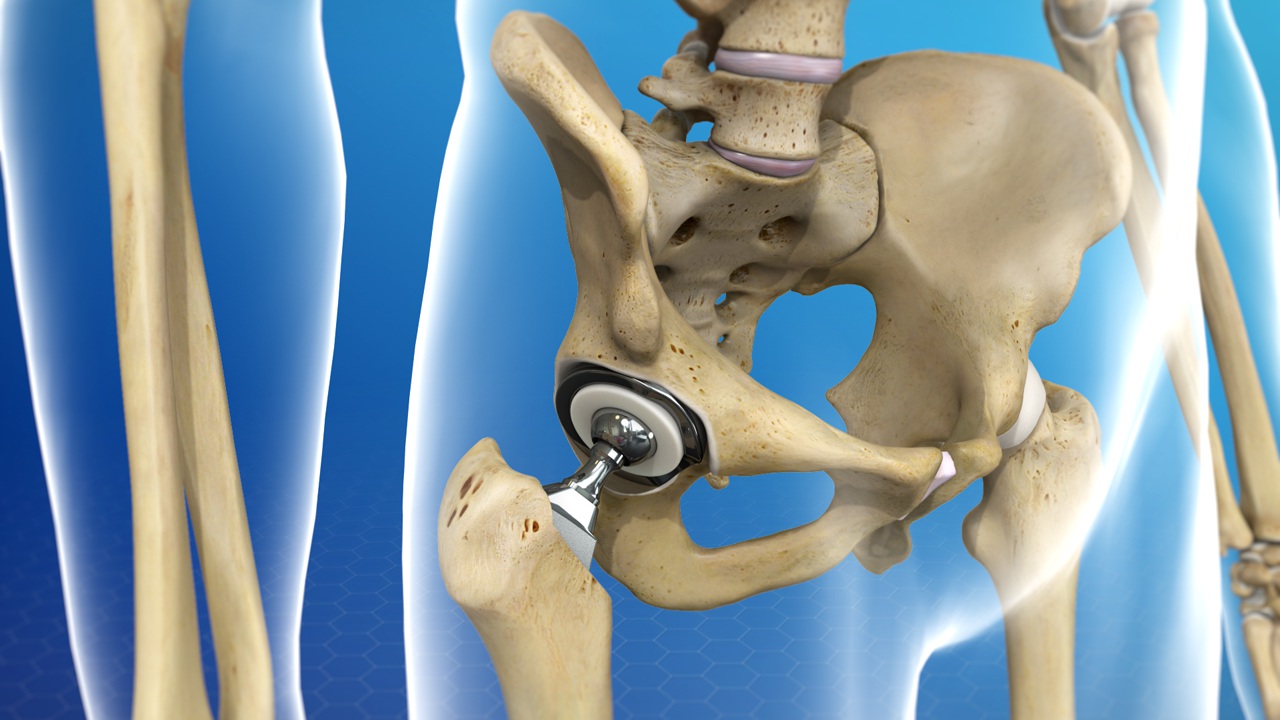 physical-therapy-for-hip-replacement-surgery